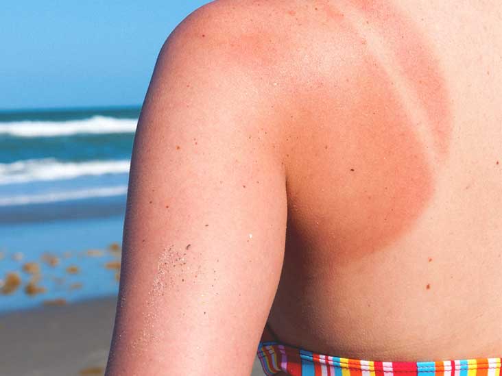 Remedies for Summer Time Maladies: Natural Care of Sunburn, Mosquito Bites, and Bee Stings